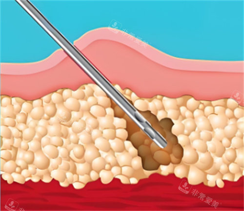 吸脂手术皮肤层
