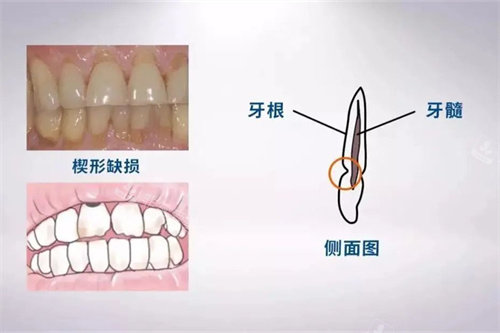 楔状缺损位置示意图