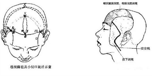 面部小切口懸吊術(shù)