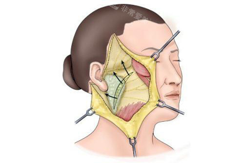 发际耳后切口拉皮手术示意图