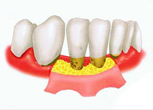 牙龈翻瓣示意图