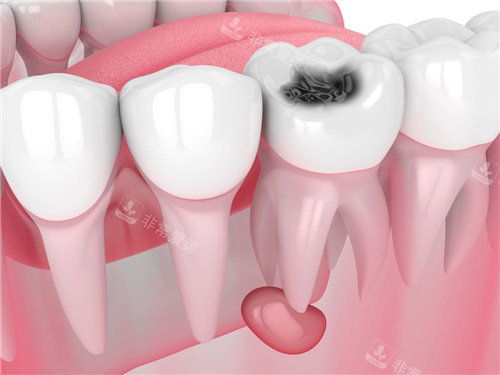 牙齿根管囊肿