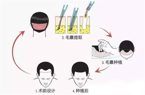 毛囊移植步驟動(dòng)畫圖 毛囊移植步驟動(dòng)畫圖