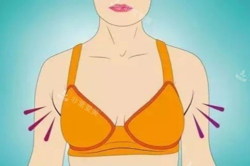 副乳图片展示