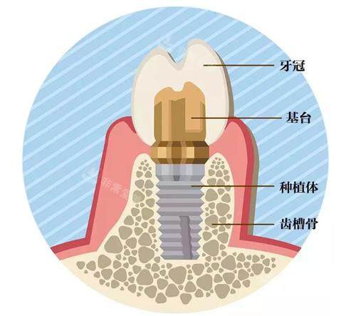 种植牙的组成
