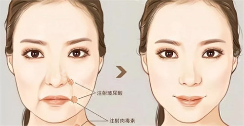 注射玻尿酸前后對(duì)比 注射玻尿酸前后對(duì)比