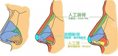 隆鼻手术对比