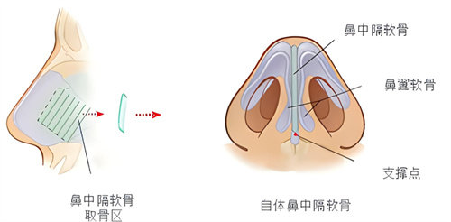 隆鼻鼻中隔軟骨鼻