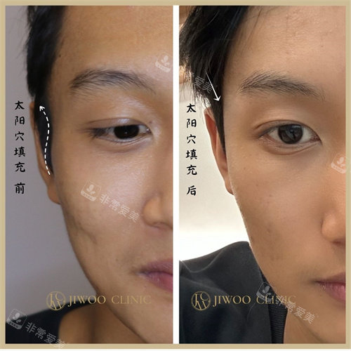 江南知友醫(yī)院太陽穴凹陷填充前后對比圖 江南知友醫(yī)院太陽穴凹陷填充前后對比圖