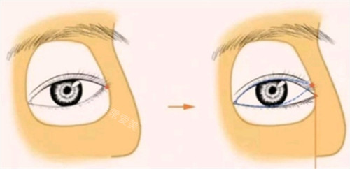 開(kāi)外眼角手術(shù)設(shè)計(jì)圖