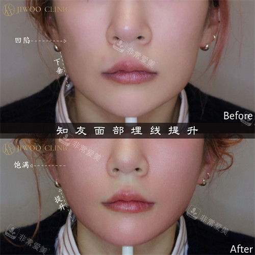 江南知友醫(yī)院埋線提升手術(shù)前后對(duì)比圖