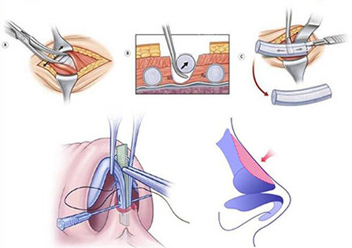 肋軟骨隆鼻改善過(guò)程圖