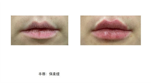BTN皮膚科嘟嘟唇 BTN皮膚科嘟嘟唇