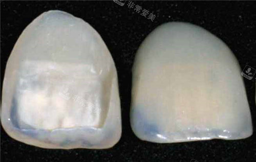 牙齿贴面成品