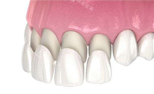 前牙四颗牙齿贴面