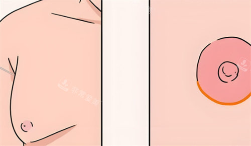 乳房縮小后術(shù)對(duì)比 乳房縮小后術(shù)對(duì)比