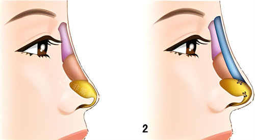 隆鼻假體對比圖示