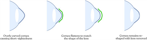 角膜塑形镜改善眼角弧度流程图