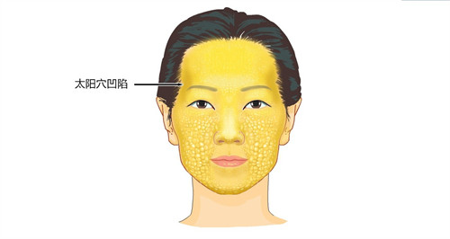 太阳穴凹陷演示动画图