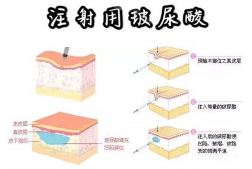 玻尿酸注射示意動畫圖