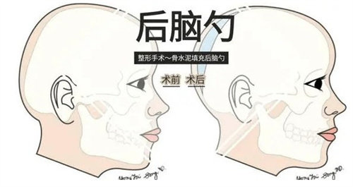 后腦勺填充手術前后 后腦勺填充手術前后
