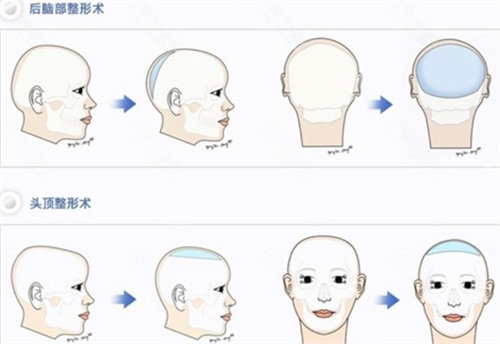后腦勺整形 后腦勺整形