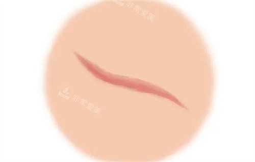 增生疤痕