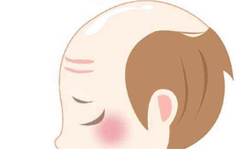 秃头 秃头