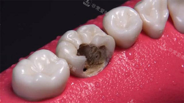 壞牙齲洞 壞牙齲洞