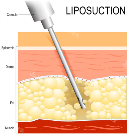 吸脂手术工作层次