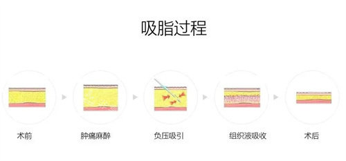 吸脂过程