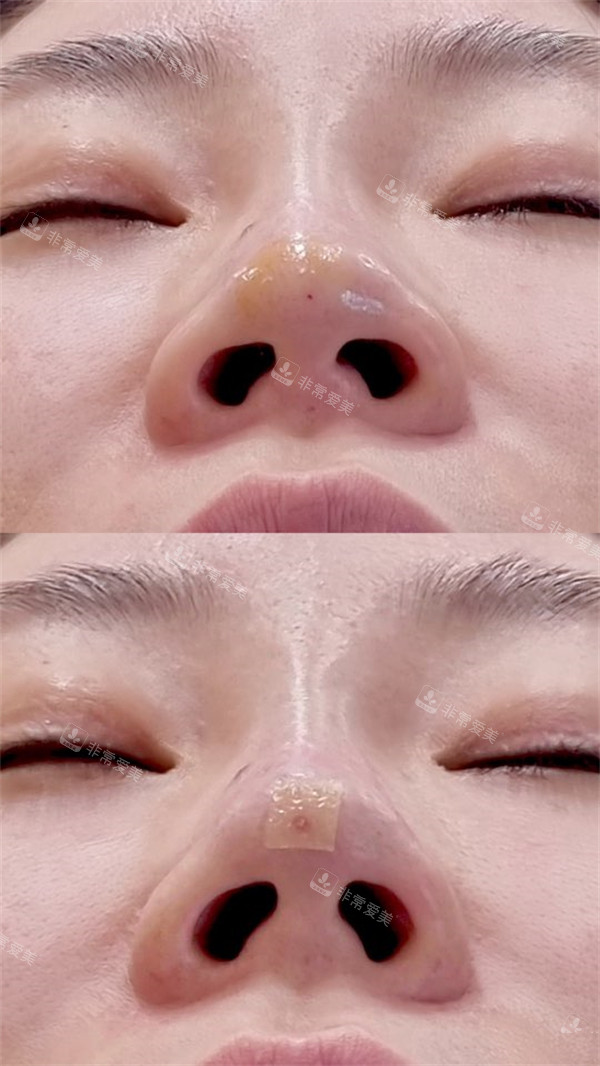 韓國清潭智溫瑜醫(yī)院鼻玻尿酸+hi鼻(線提升)對比圖 韓國清潭智溫瑜醫(yī)院鼻玻尿酸+hi鼻(線提升)對比圖