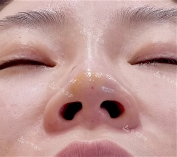 韓國清潭智溫瑜醫(yī)院玻尿酸隆鼻術(shù)前圖 韓國清潭智溫瑜醫(yī)院玻尿酸隆鼻術(shù)前圖