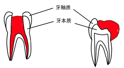 牙齿内息肉外溢
