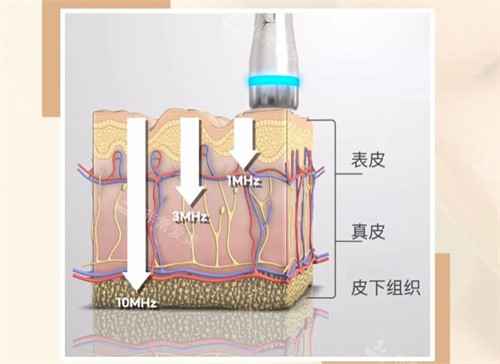 LDM水滴提升是什么 LDM水滴提升是什么