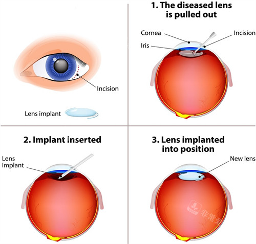 晶体植入手术过程