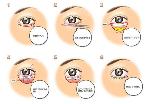 眼瞼下至手術(shù)方法