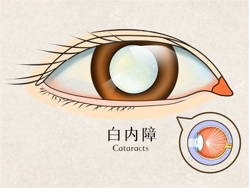 白内障手术图片