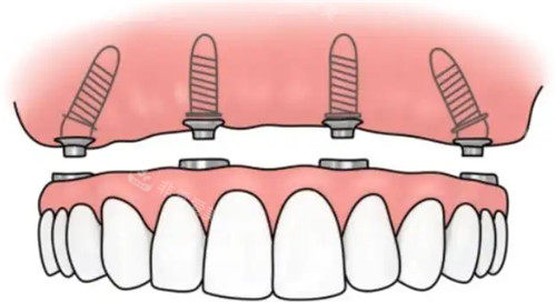 半固定种植牙卡通图
