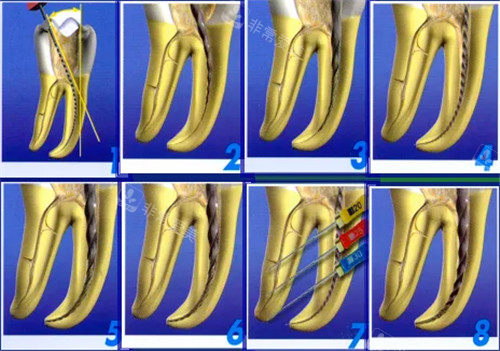 根管治疗步骤图细节