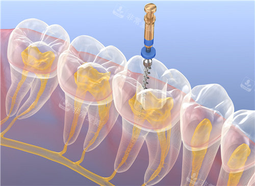 根管治疗透视图