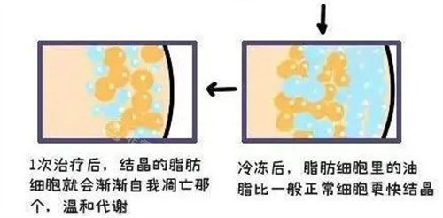 韩国做抽脂手术多少钱？韩国吸脂医院都是按部位收费基本均价是5000起步！