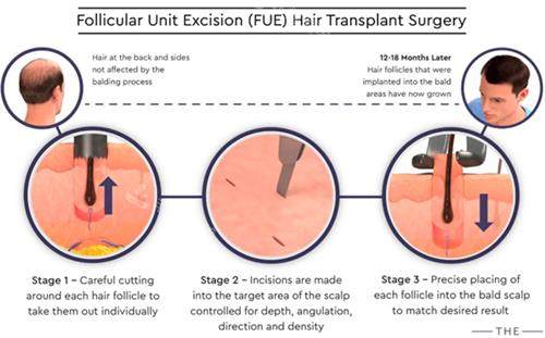 毛囊移植過程圖解