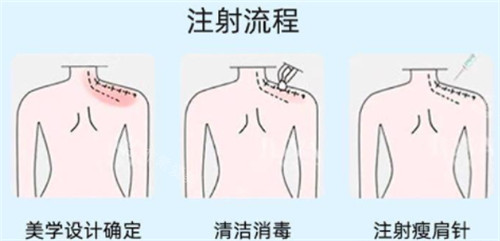 瘦肩注射点位图