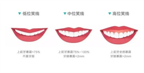 微笑線是什么？