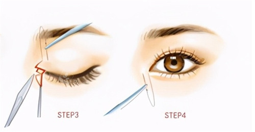 內(nèi)眼角的手術(shù)過程 內(nèi)眼角的手術(shù)過程