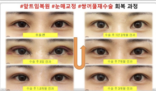 sone整形眼整形前后對比 sone整形眼整形前后對比