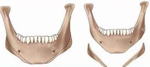 下颌角削骨前后对比