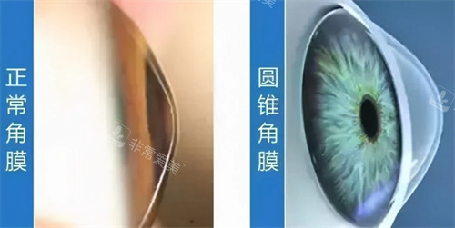 圆锥角膜和正常角膜的区别图解