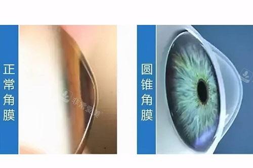 圆锥角膜与正常角膜对比图